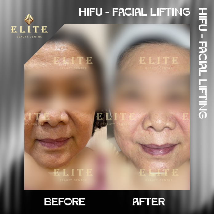 Hifu-Facial lifting